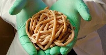 Parasiten aus dem mënschleche Kierper extrahéiert