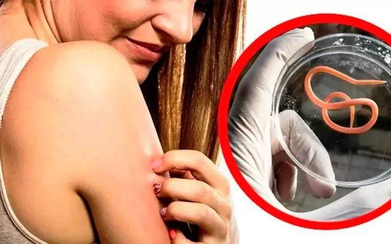 Jucken an Reizung duerch Parasiten am Kierper