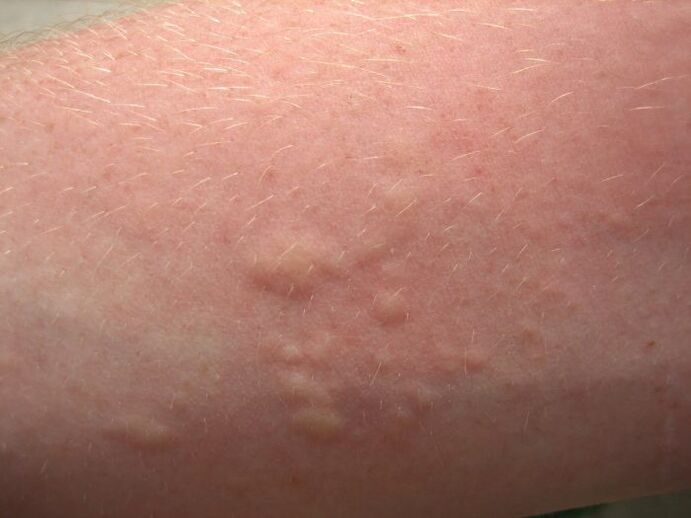 juckend allergesch Hautausschläge kënnen Symptomer vun Ascariasis sinn